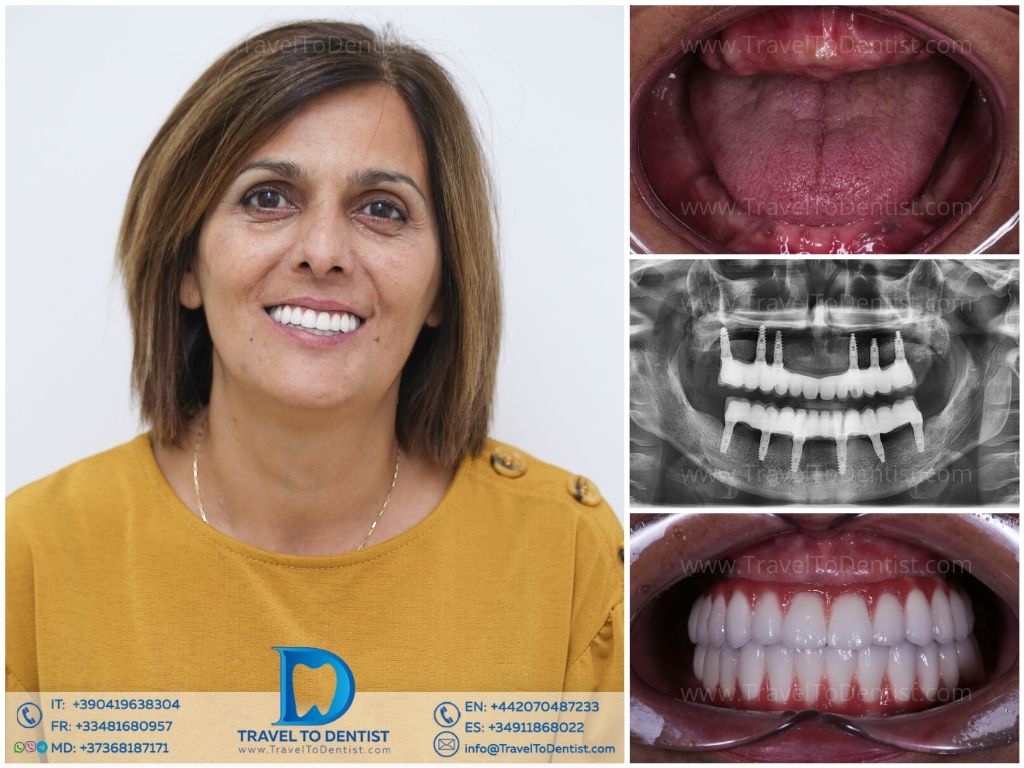 Caso dental antes y después - Caso 5